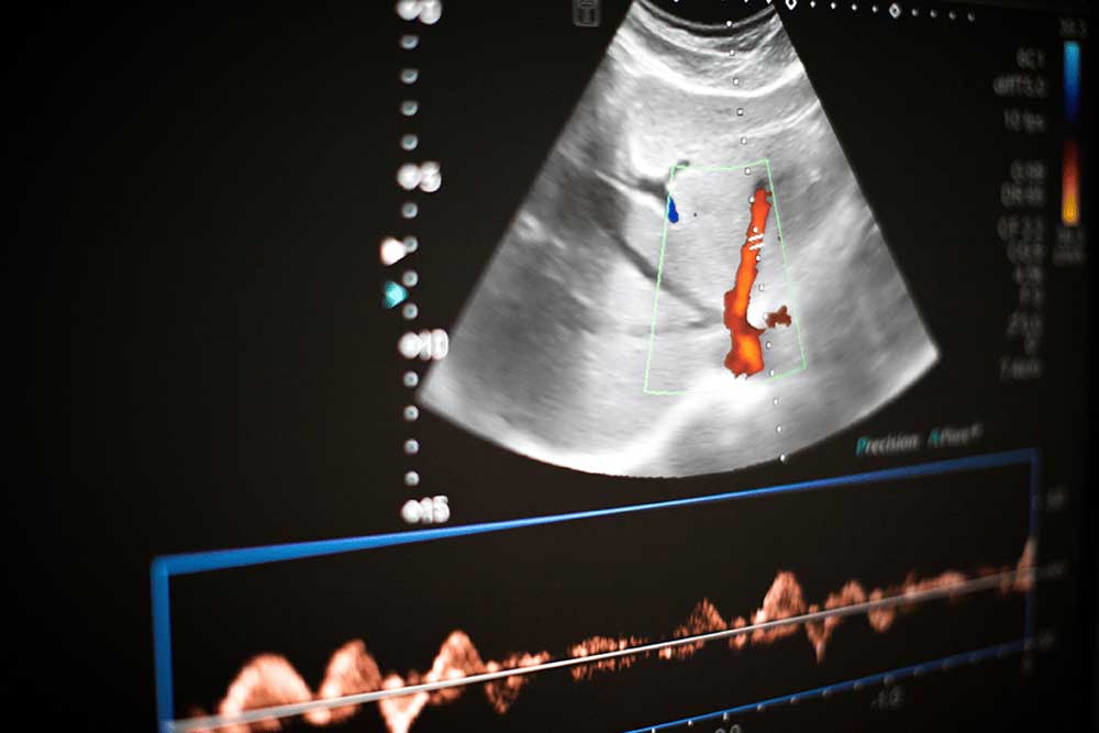 ultrasonografia