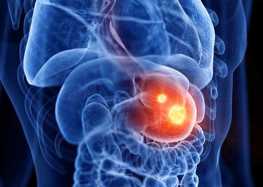 Cáncer Gástrico