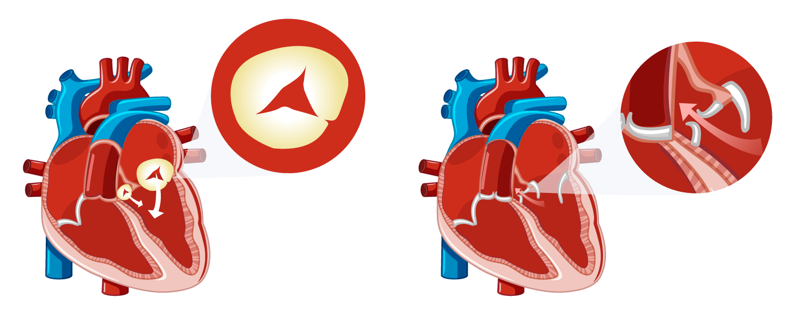 corazones muestran insuficiencia cardiaca
